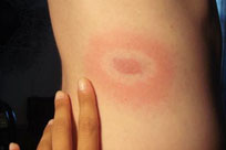 Lyme Disease bullseye rash