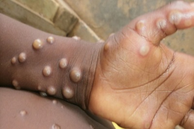 monkeypox lesions